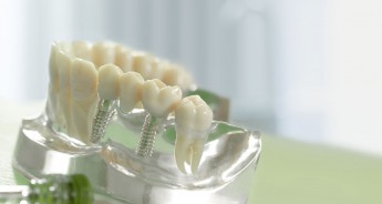 Implantologie / Zahnimplantate